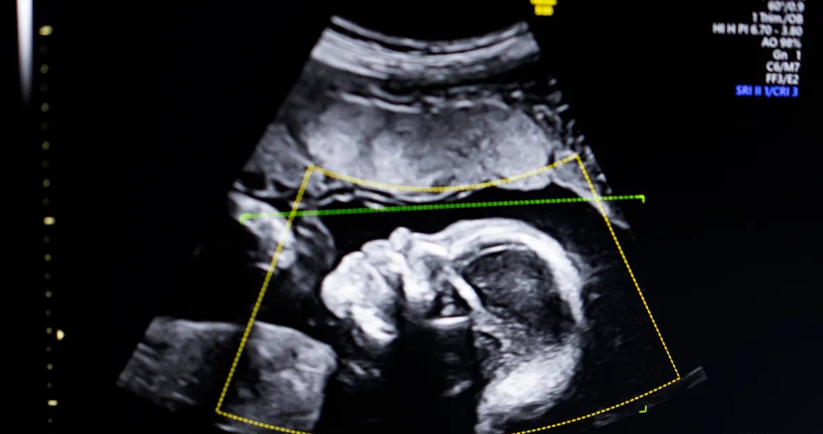 BioticsAI obtém aval da FDA para software de ultrassom fetal com inteligência artificial - Imagem do artigo