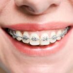 Metade das crianças precisa de aparelho ortodôntico; saiba onde buscar tratamento mais barato no ES