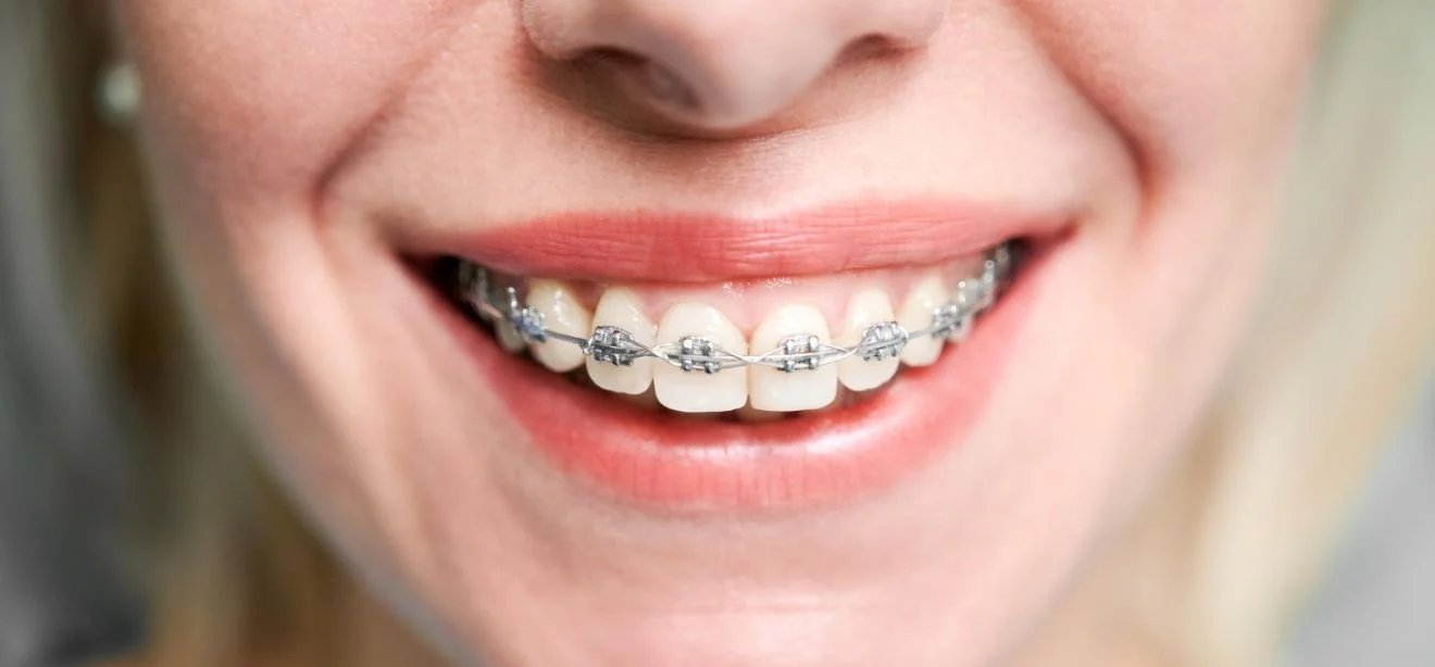 Metade das crianças precisa de aparelho ortodôntico; saiba onde buscar tratamento mais barato no ES - Imagem do artigo